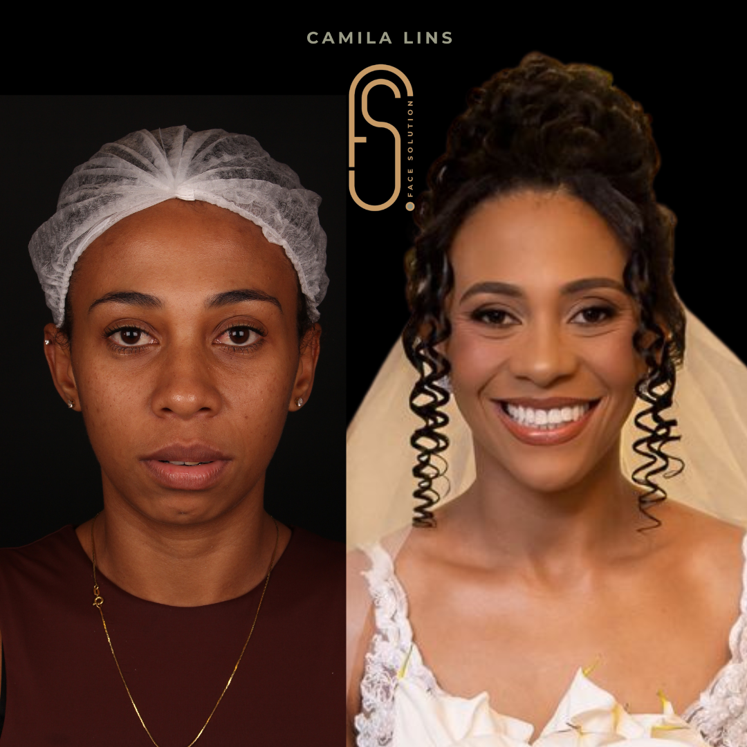 Antes e depois - caso clínico Dra. Camila Lins
